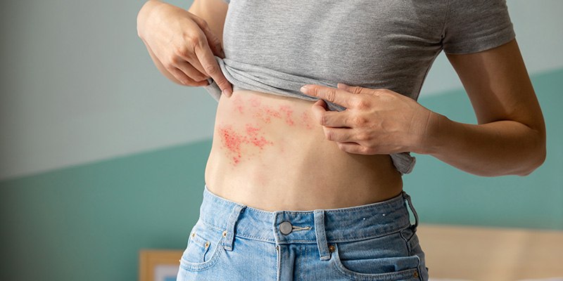 Herpes zoster: Hintergrundwissen und Tipps für die Beratung